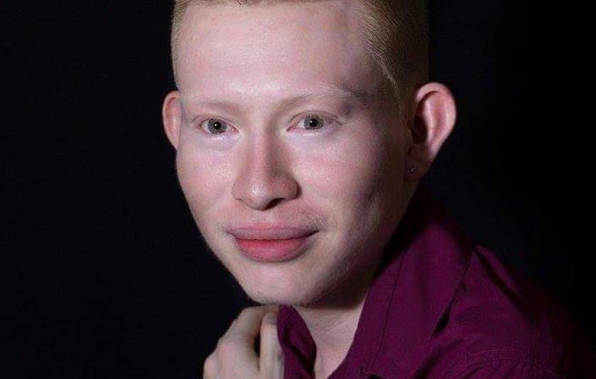 Photo: albino man 